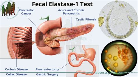 The role of fecal elastase